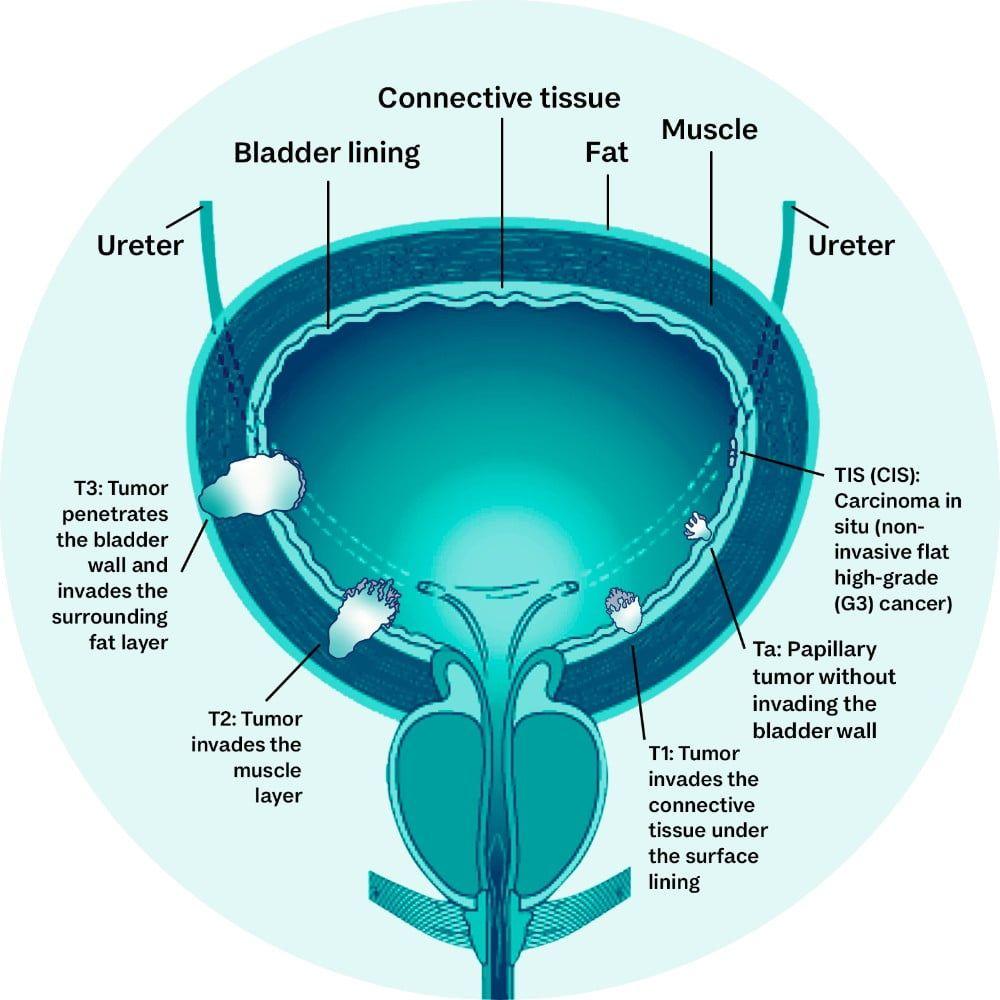 Diagram of bladder and tumor types